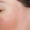 Hyperpigmentation Spot Removal